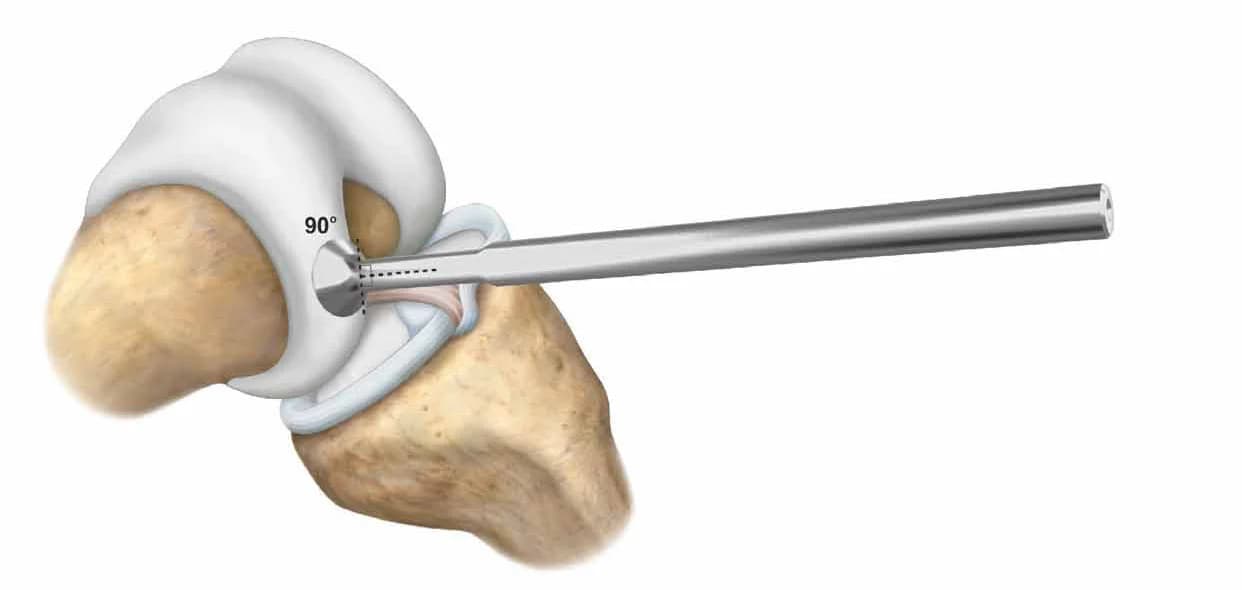 CartiHeal alignment guide over an osteochondral knee lesion