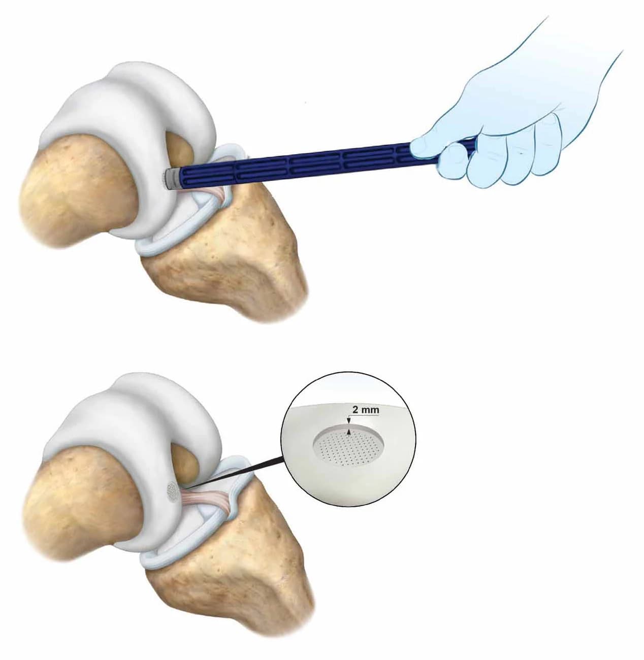 CartiHeal implant seated beneath the cartilage surface